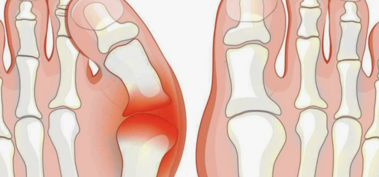 Keseimbangan Langkah: Pentingnya Distribusi  Beban untuk Mencegah Kelelahan Akibat Valgus